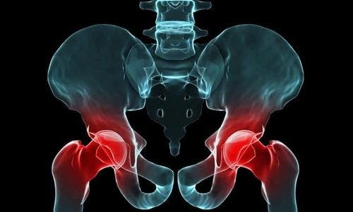 Affordable Hip Replacement in the UK: The Horder Centre's promise of quality at a fair price